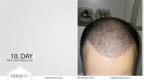 hermes haartransplantation istanbul|hermest hair transplant turkey.